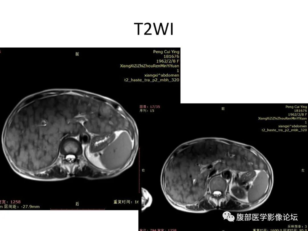 影像PPT - 【病例】肝脏弥漫B细胞淋巴瘤1例CT及MR-14