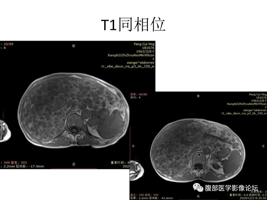 影像PPT - 【病例】肝脏弥漫B细胞淋巴瘤1例CT及MR-13