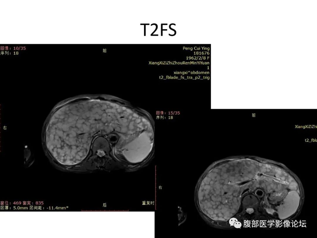 影像PPT - 【病例】肝脏弥漫B细胞淋巴瘤1例CT及MR-15
