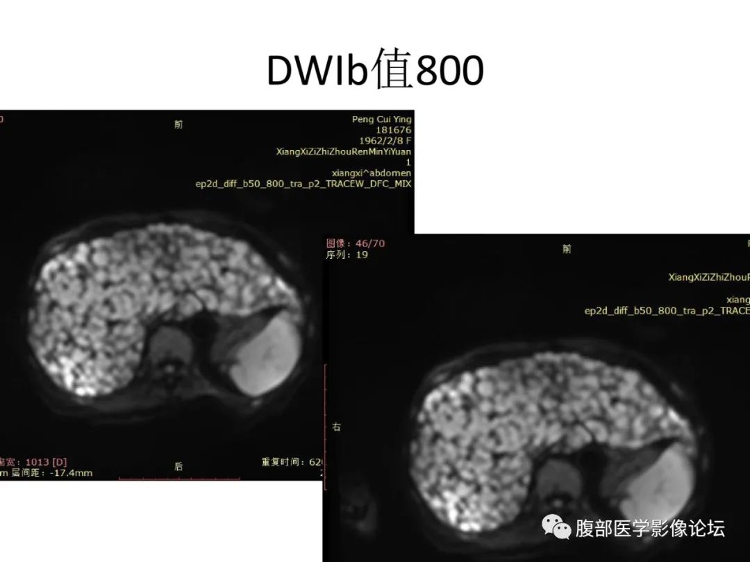 影像PPT - 【病例】肝脏弥漫B细胞淋巴瘤1例CT及MR-17