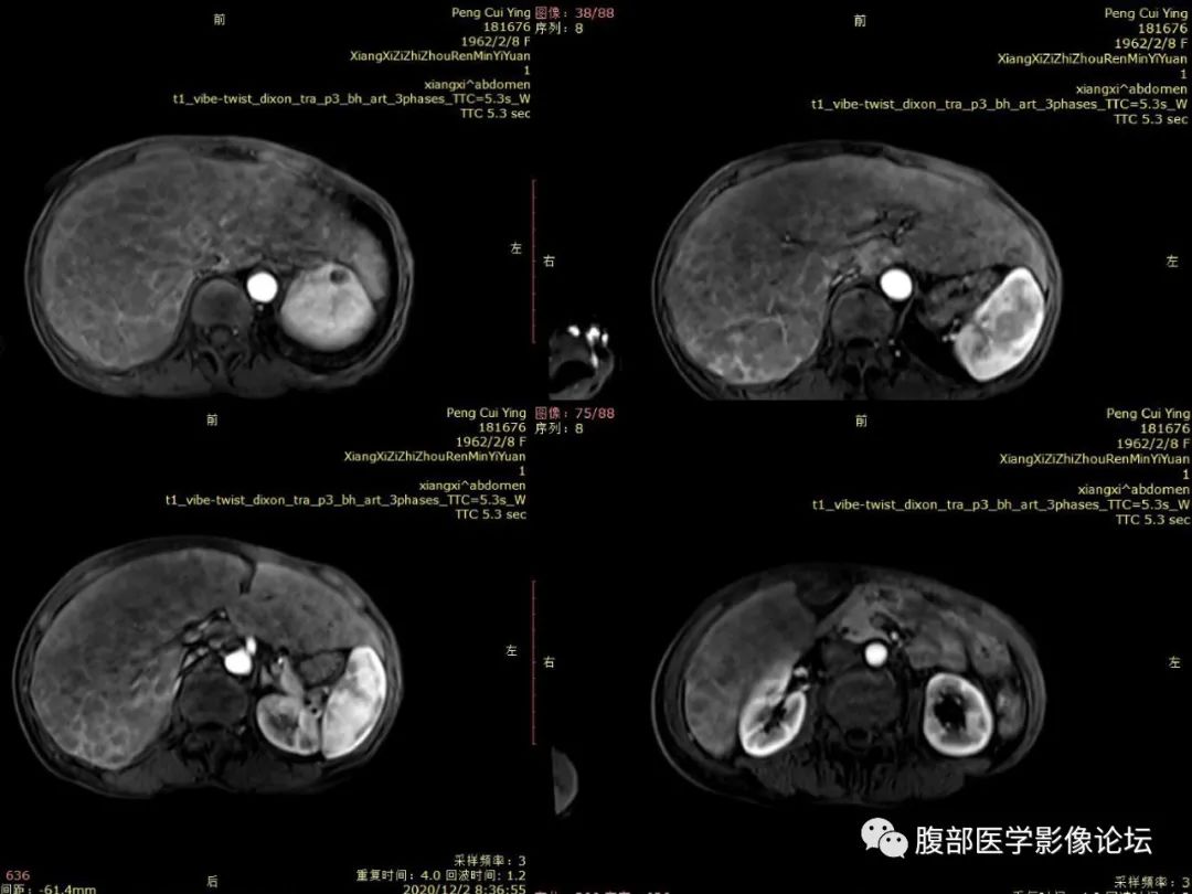 影像PPT - 【病例】肝脏弥漫B细胞淋巴瘤1例CT及MR-19