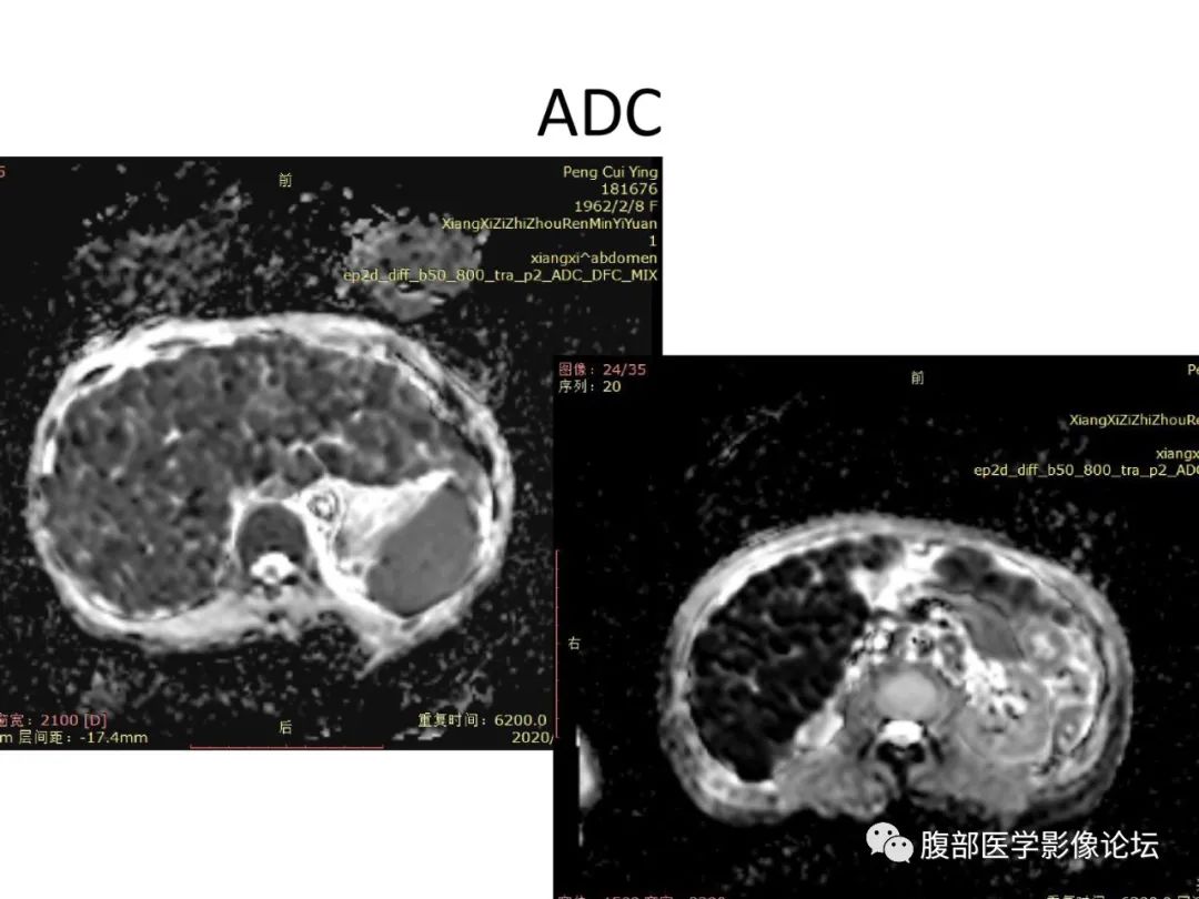 影像PPT - 【病例】肝脏弥漫B细胞淋巴瘤1例CT及MR-18