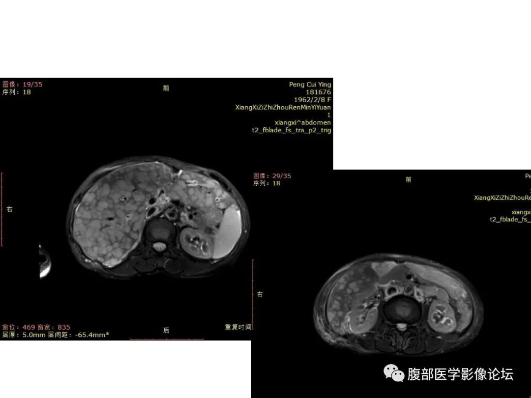影像PPT - 【病例】肝脏弥漫B细胞淋巴瘤1例CT及MR-16