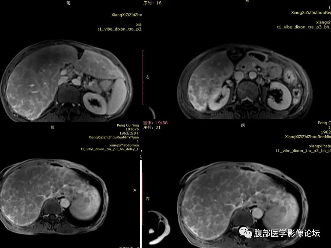 影像PPT - 【病例】肝脏弥漫B细胞淋巴瘤1例CT及MR-23