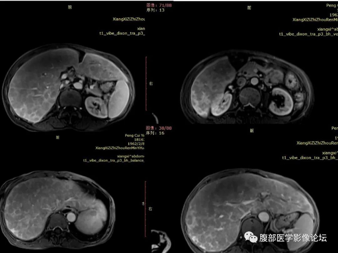 影像PPT - 【病例】肝脏弥漫B细胞淋巴瘤1例CT及MR-22