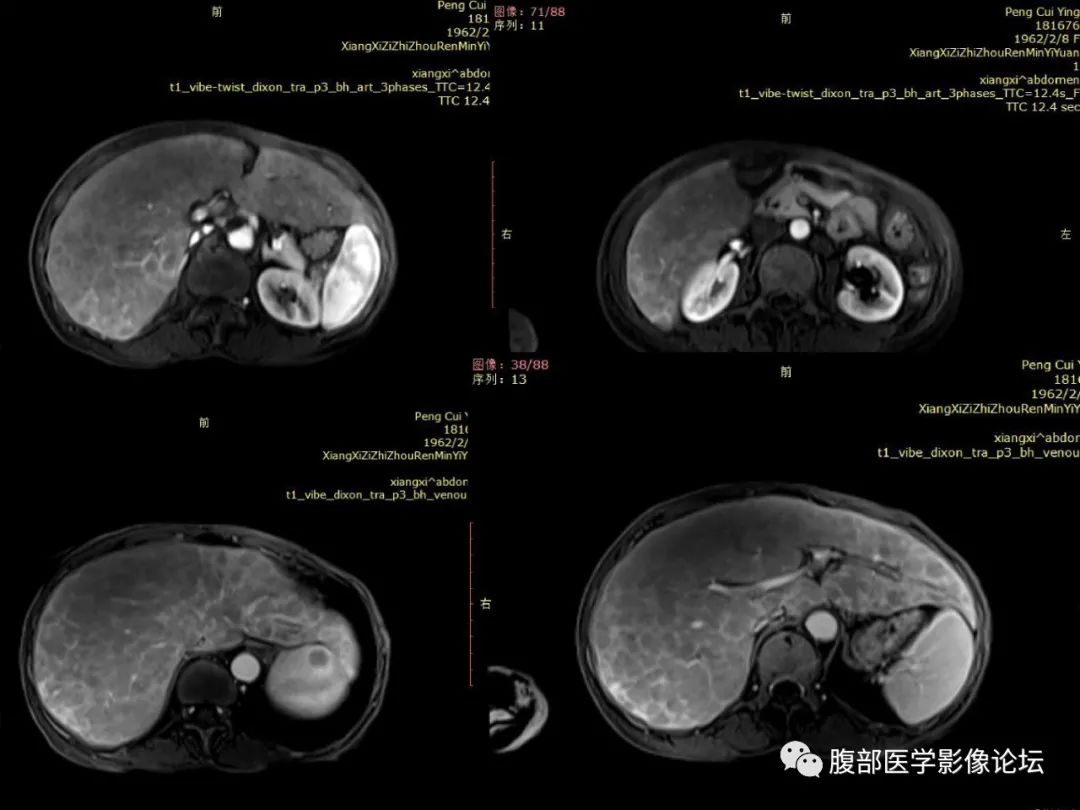 影像PPT - 【病例】肝脏弥漫B细胞淋巴瘤1例CT及MR-21