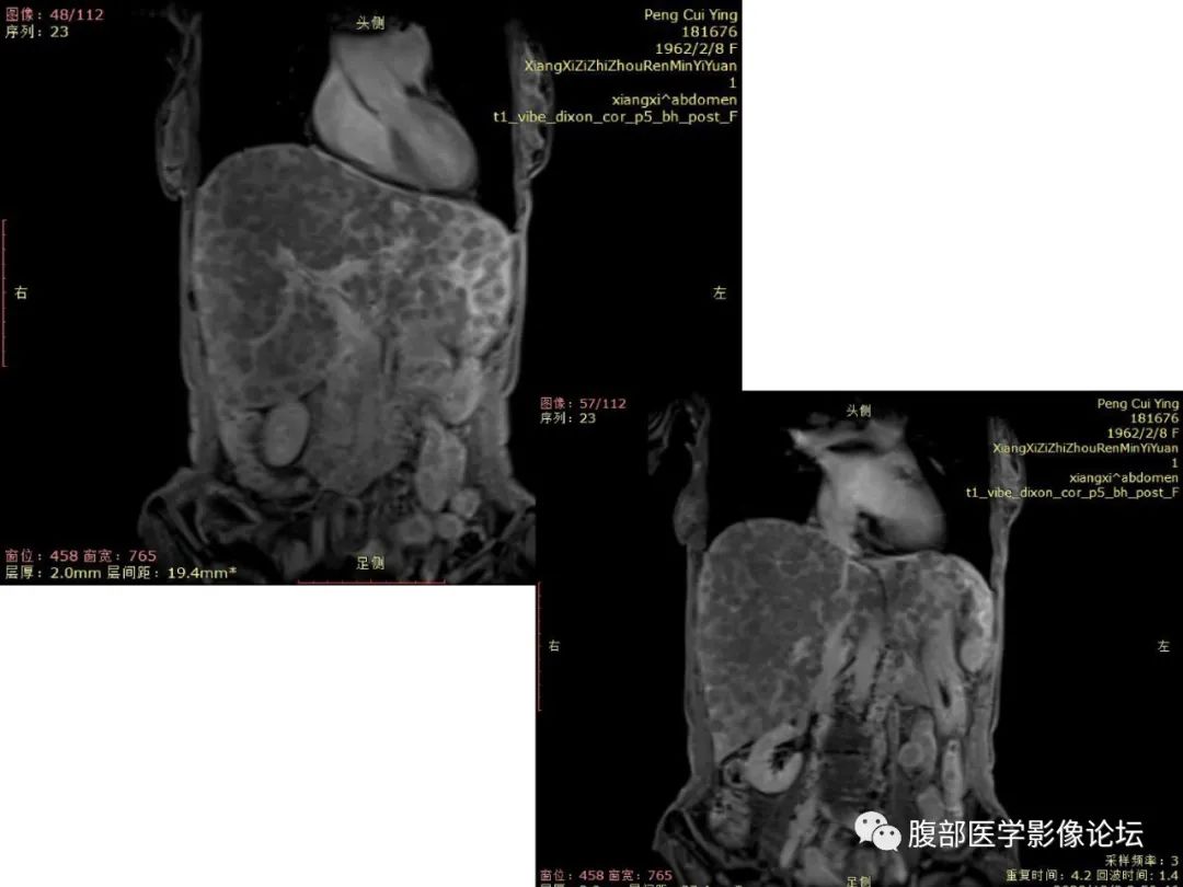 影像PPT - 【病例】肝脏弥漫B细胞淋巴瘤1例CT及MR-25