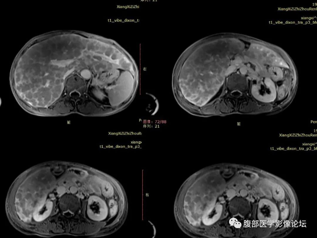 影像PPT - 【病例】肝脏弥漫B细胞淋巴瘤1例CT及MR-24