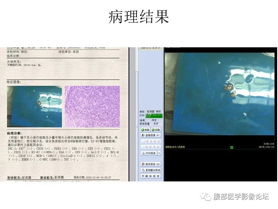 影像PPT - 【病例】肝脏弥漫B细胞淋巴瘤1例CT及MR-31