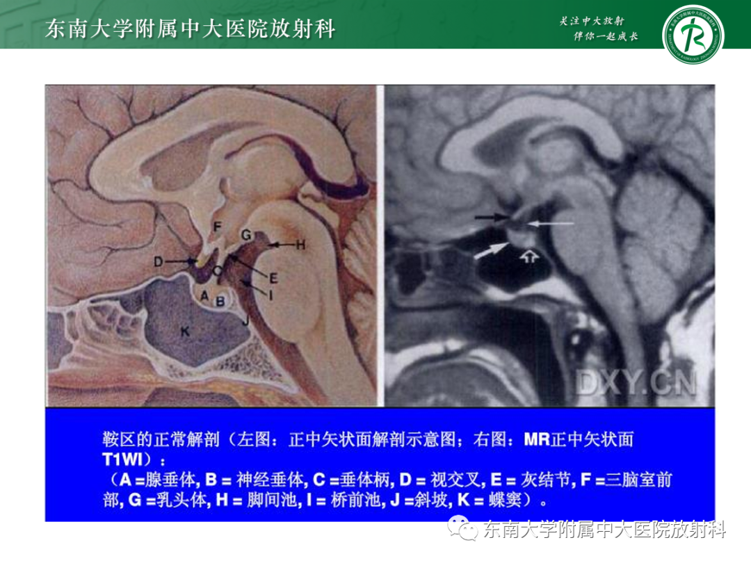 影像PPT - 【PPT】垂体Rathke囊肿的MRI表现-6