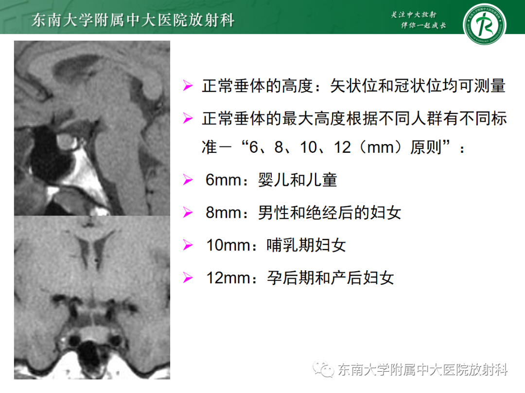 影像PPT - 【PPT】垂体Rathke囊肿的MRI表现-8