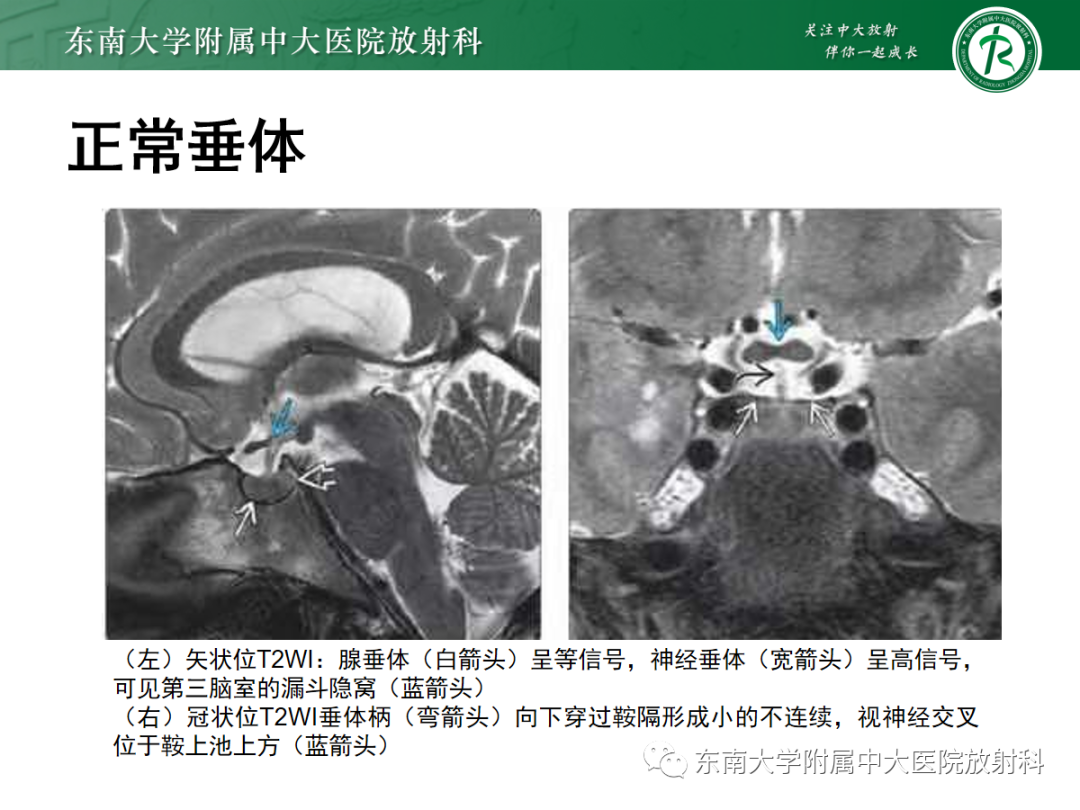 影像PPT - 【PPT】垂体Rathke囊肿的MRI表现-11