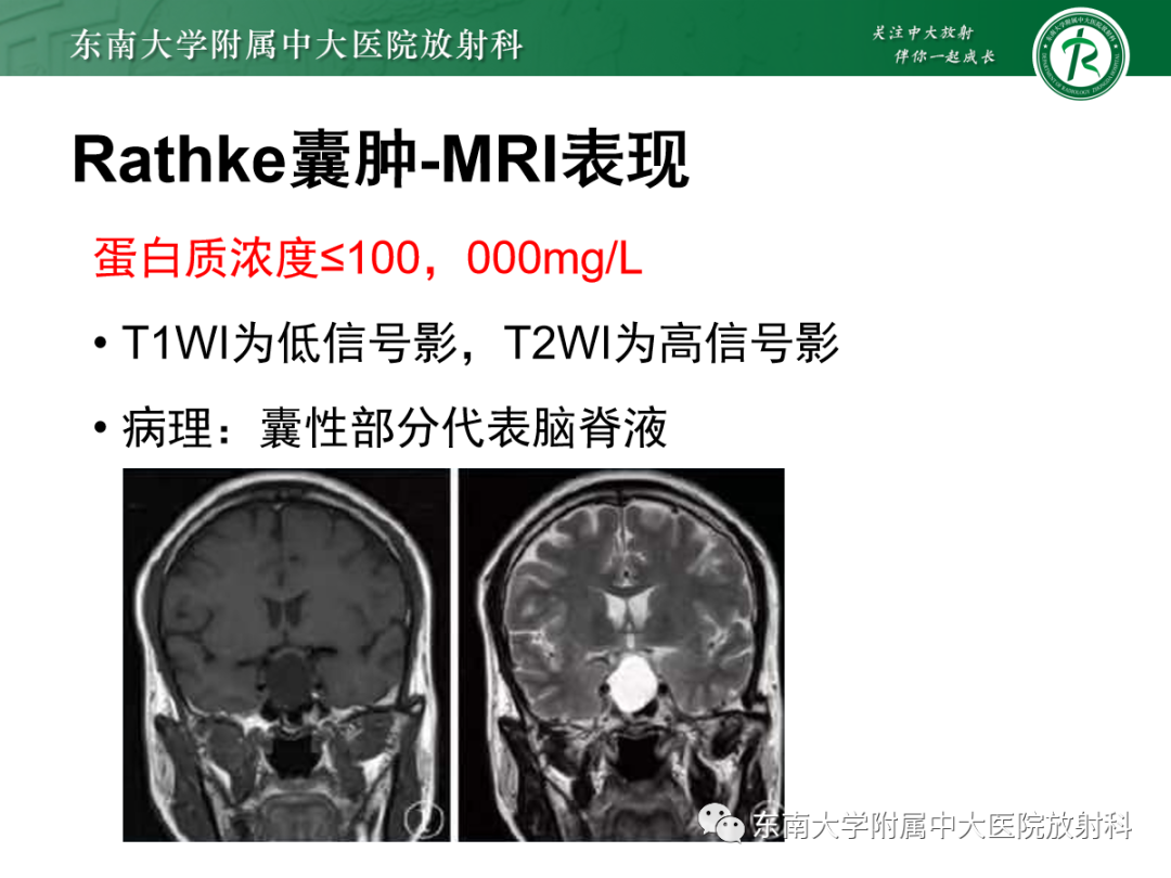 影像PPT - 【PPT】垂体Rathke囊肿的MRI表现-18