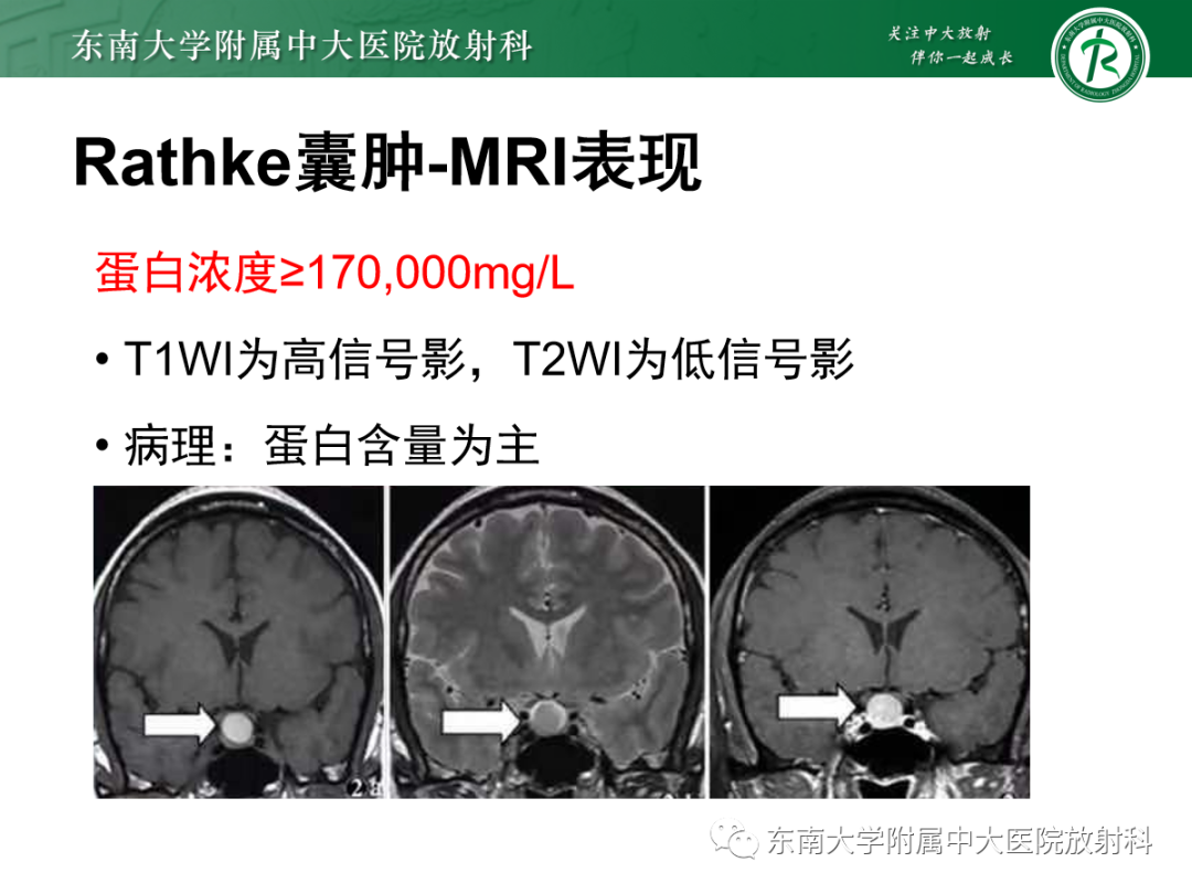 影像PPT - 【PPT】垂体Rathke囊肿的MRI表现-20
