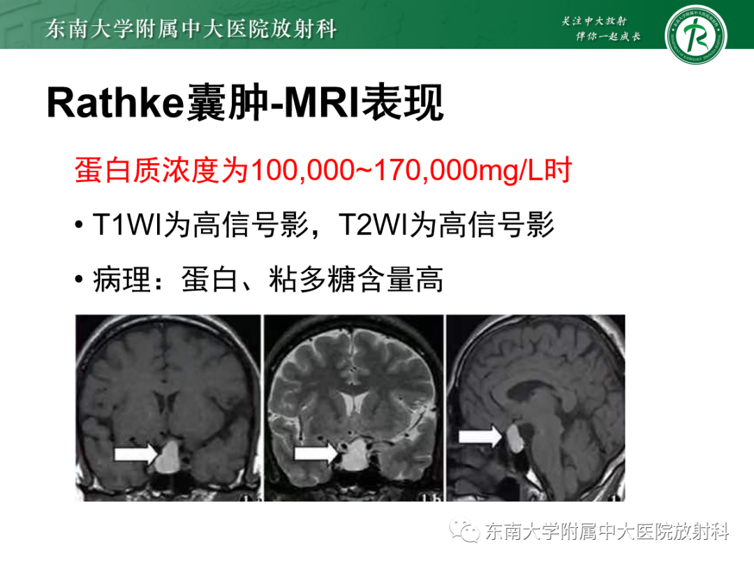 影像PPT - 【PPT】垂体Rathke囊肿的MRI表现-19