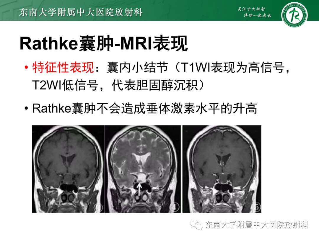 影像PPT - 【PPT】垂体Rathke囊肿的MRI表现-21