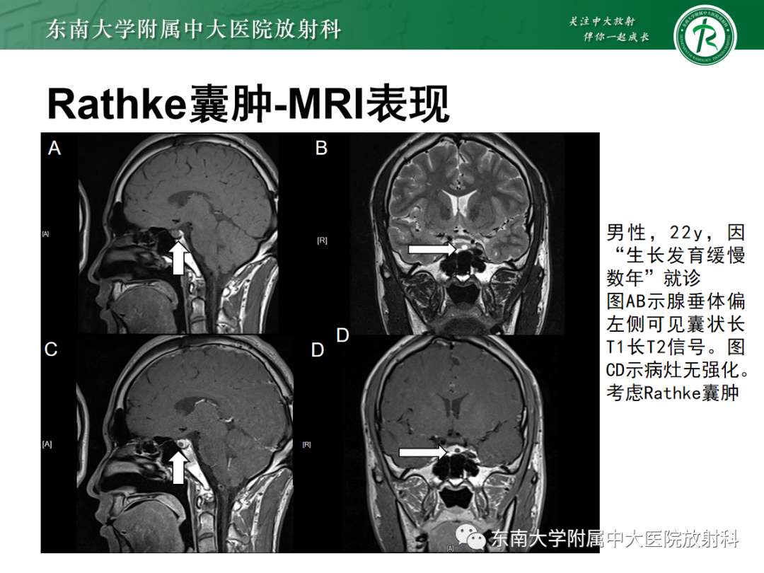 影像PPT - 【PPT】垂体Rathke囊肿的MRI表现-22