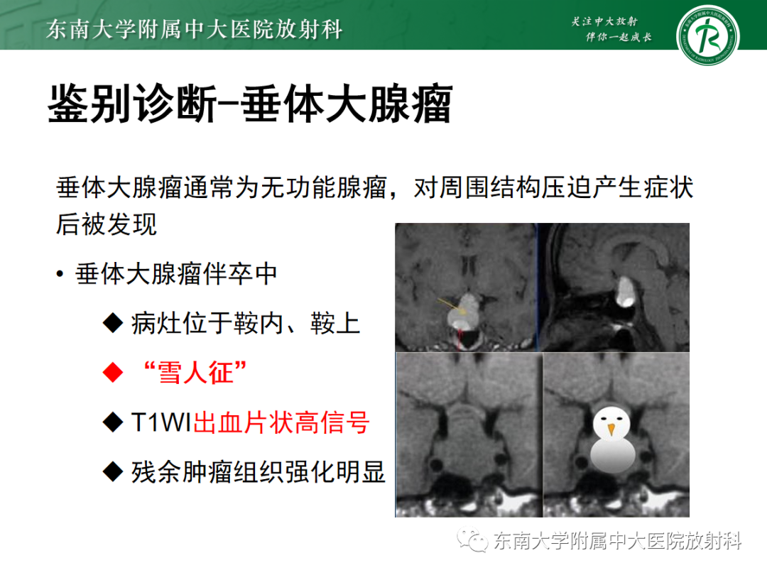影像PPT - 【PPT】垂体Rathke囊肿的MRI表现-27
