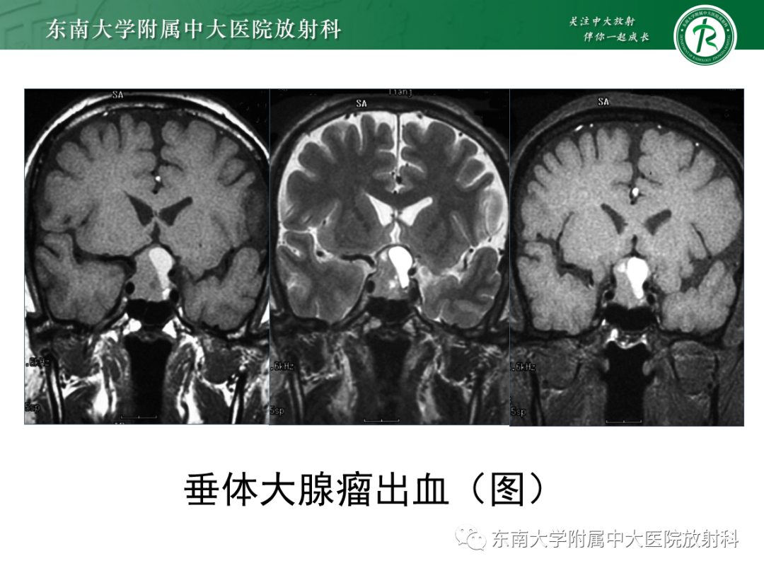 影像PPT - 【PPT】垂体Rathke囊肿的MRI表现-29