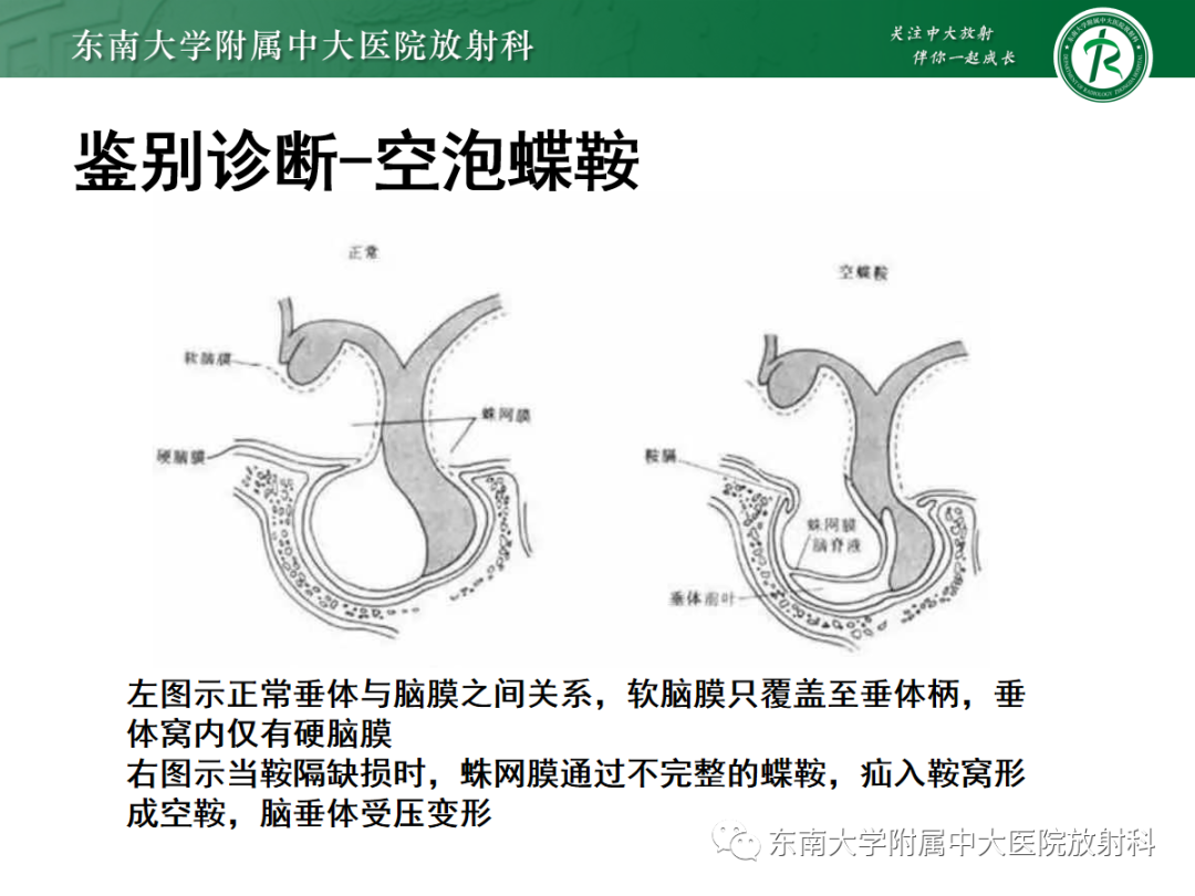 影像PPT - 【PPT】垂体Rathke囊肿的MRI表现-34