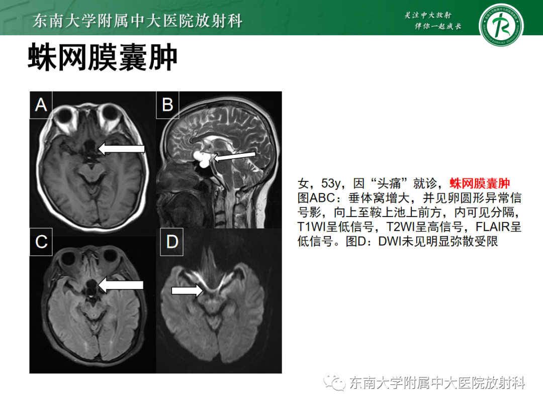 影像PPT - 【PPT】垂体Rathke囊肿的MRI表现-38