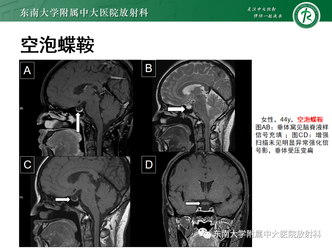 影像PPT - 【PPT】垂体Rathke囊肿的MRI表现-35