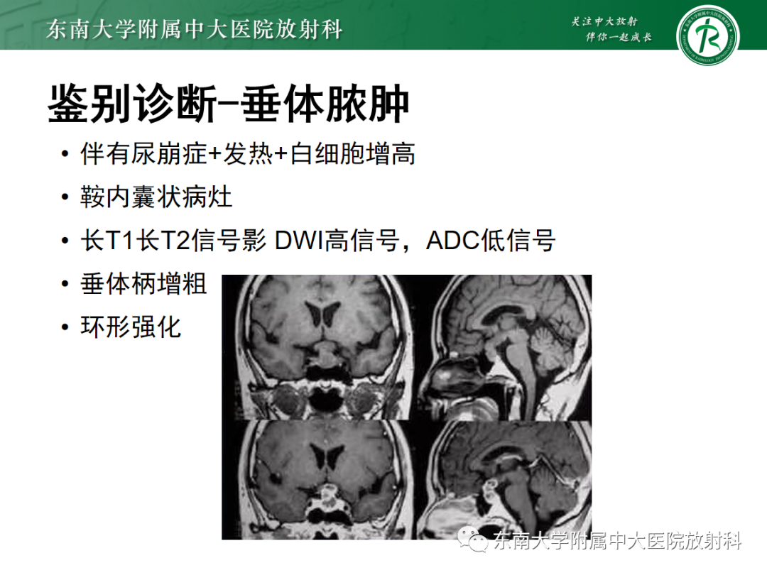 影像PPT - 【PPT】垂体Rathke囊肿的MRI表现-39
