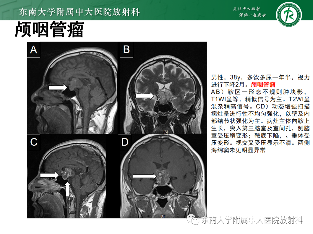影像PPT - 【PPT】垂体Rathke囊肿的MRI表现-33