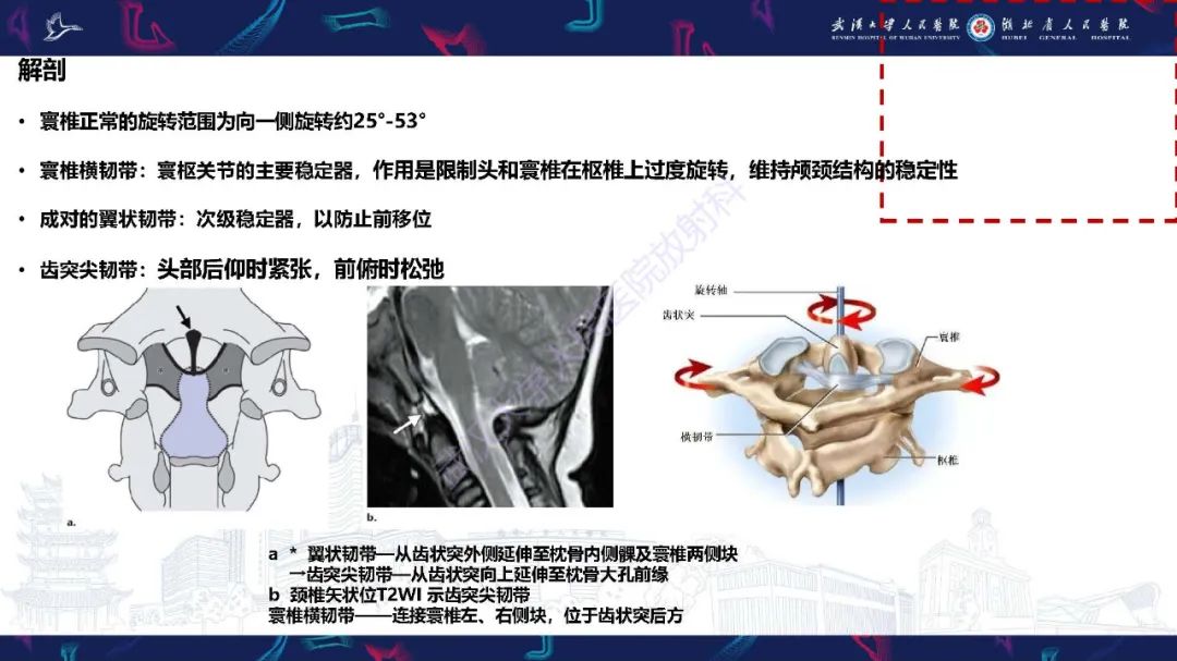 影像PPT - 【PPT】儿童斜颈影像诊断-6