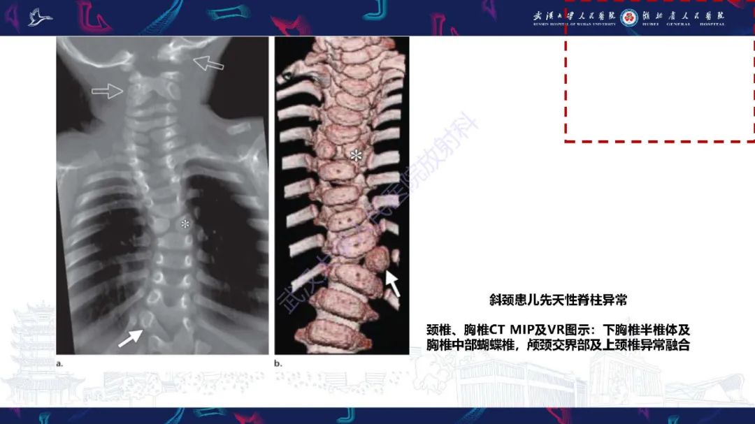 影像PPT - 【PPT】儿童斜颈影像诊断-12