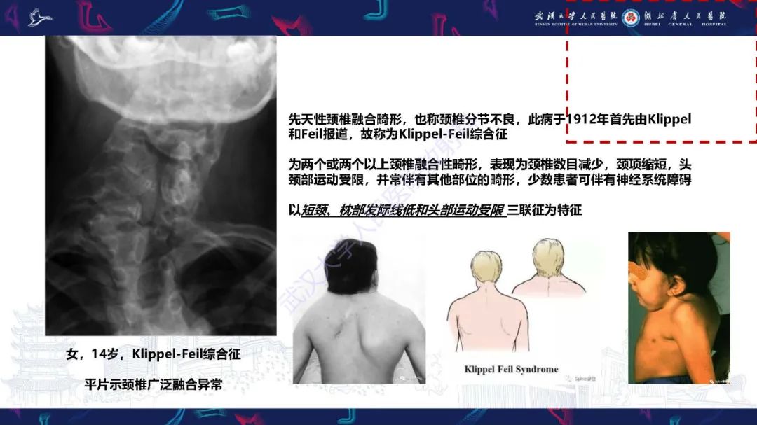 影像PPT - 【PPT】儿童斜颈影像诊断-14