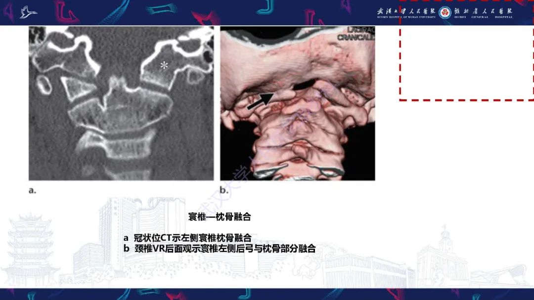 影像PPT - 【PPT】儿童斜颈影像诊断-13