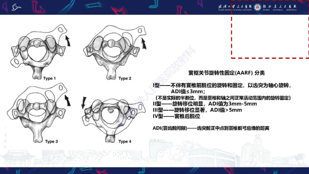 影像PPT - 【PPT】儿童斜颈影像诊断-16