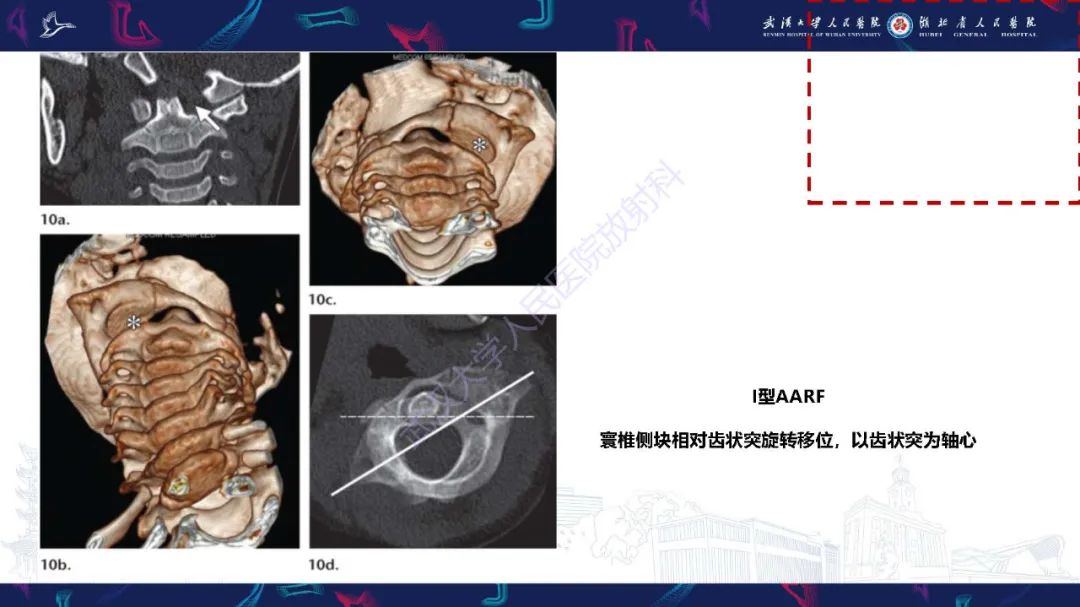 影像PPT - 【PPT】儿童斜颈影像诊断-17