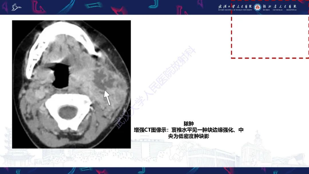 影像PPT - 【PPT】儿童斜颈影像诊断-20