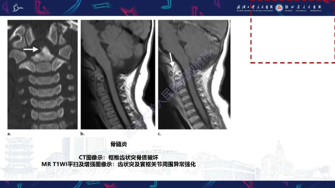 影像PPT - 【PPT】儿童斜颈影像诊断-21