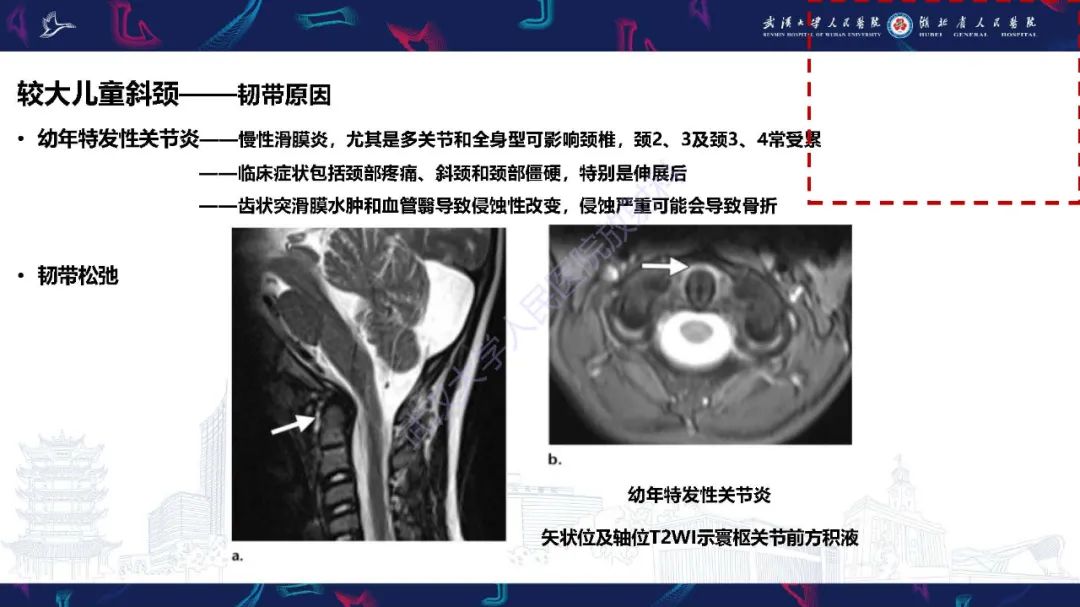 影像PPT - 【PPT】儿童斜颈影像诊断-22