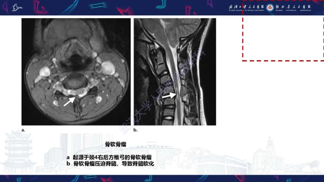 影像PPT - 【PPT】儿童斜颈影像诊断-24
