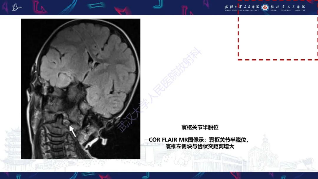 影像PPT - 【PPT】儿童斜颈影像诊断-18