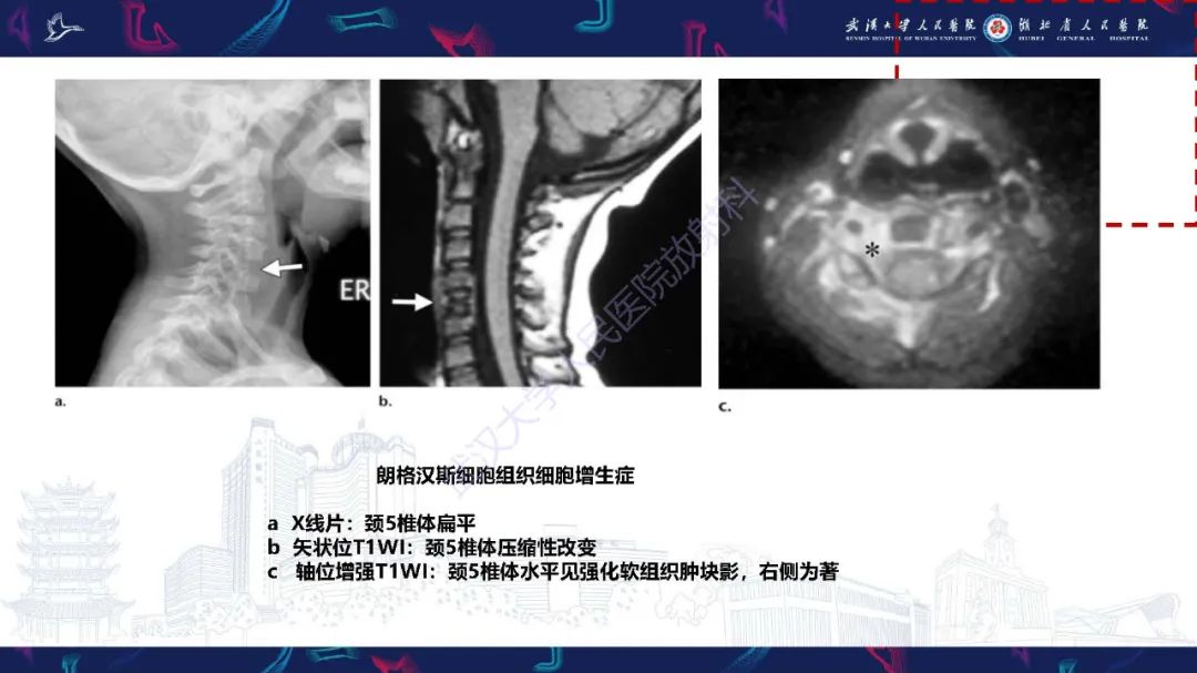 影像PPT - 【PPT】儿童斜颈影像诊断-25