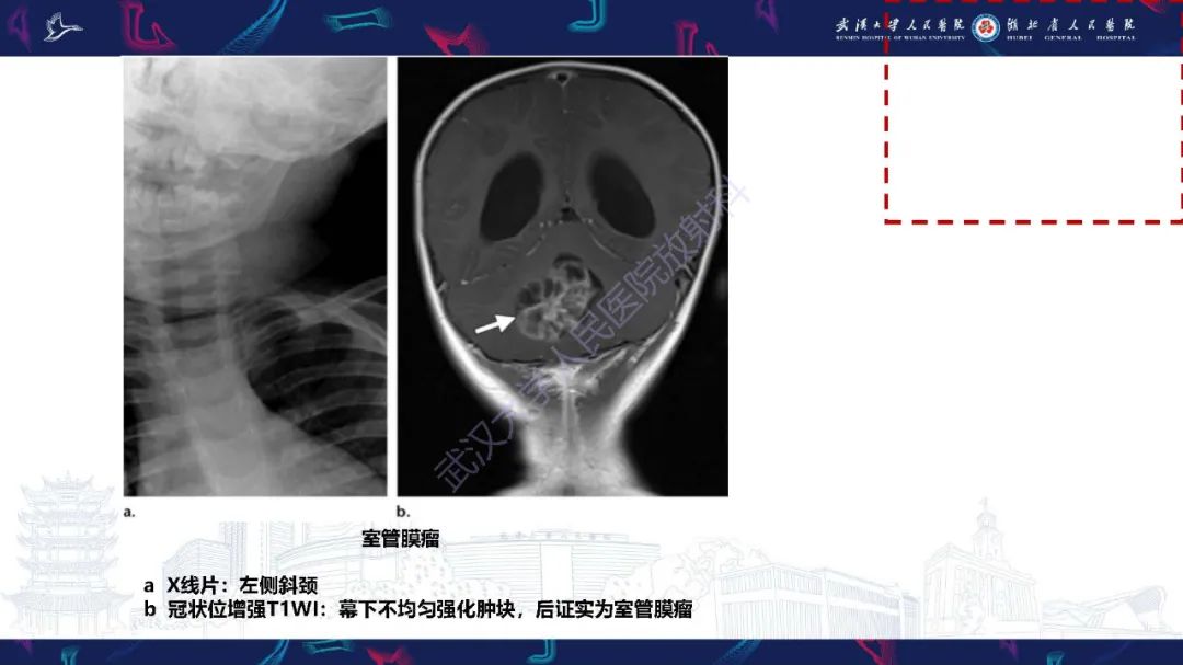影像PPT - 【PPT】儿童斜颈影像诊断-26
