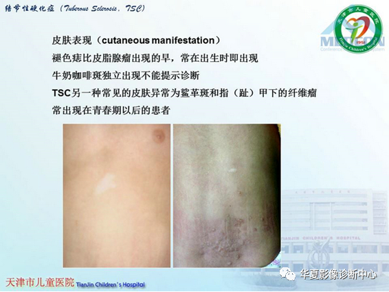 影像PPT - 【PPT】儿童常见神经皮肤综合征影像诊断-10