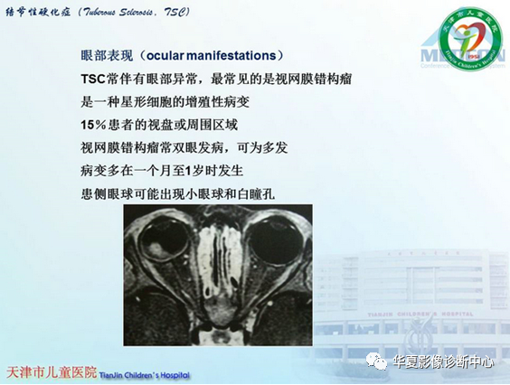 影像PPT - 【PPT】儿童常见神经皮肤综合征影像诊断-11