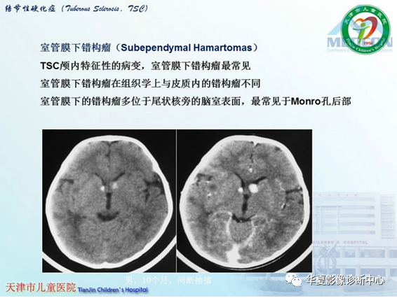 影像PPT - 【PPT】儿童常见神经皮肤综合征影像诊断-12