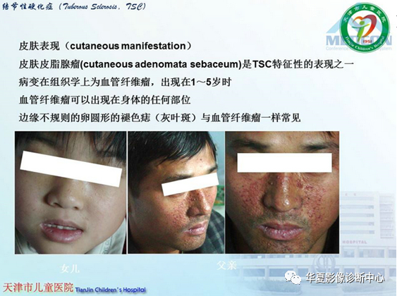 影像PPT - 【PPT】儿童常见神经皮肤综合征影像诊断-9