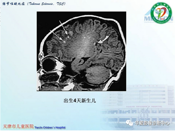 影像PPT - 【PPT】儿童常见神经皮肤综合征影像诊断-14