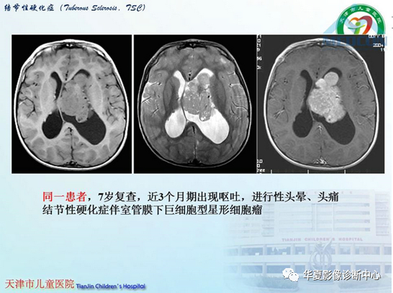 影像PPT - 【PPT】儿童常见神经皮肤综合征影像诊断-19