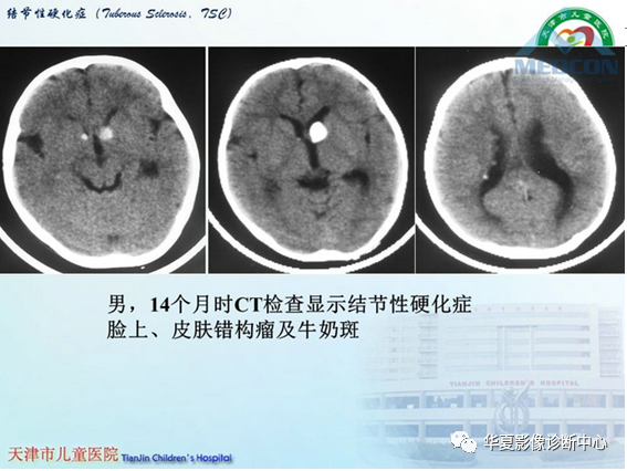影像PPT - 【PPT】儿童常见神经皮肤综合征影像诊断-18