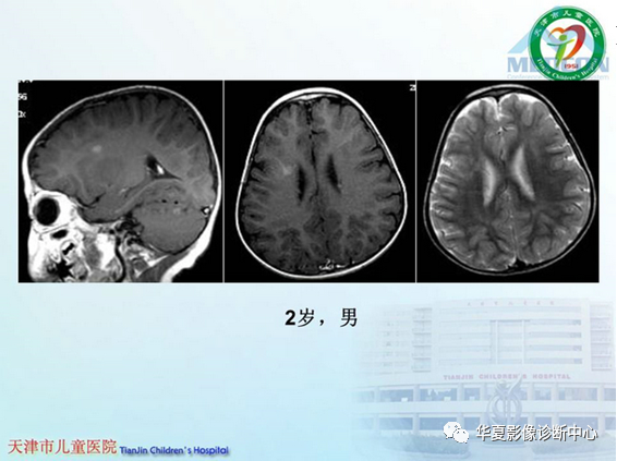 影像PPT - 【PPT】儿童常见神经皮肤综合征影像诊断-21