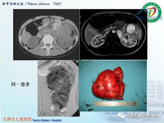 影像PPT - 【PPT】儿童常见神经皮肤综合征影像诊断-24